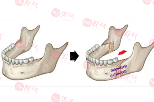 上海九院正頜手術(shù)費(fèi)用揭秘，快速了解報(bào)銷(xiāo)標(biāo)準(zhǔn)，省錢(qián)又安心！