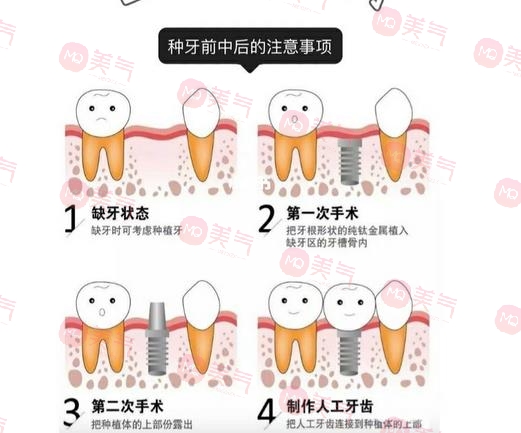 上海種植牙價格表大全更新！低至5900？內(nèi)附種植牙原理、注意事項