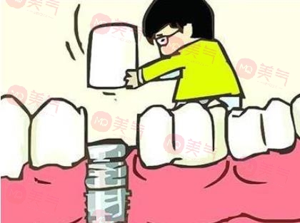 上海種植牙價格表大全更新！低至5900？內(nèi)附種植牙原理、注意事項