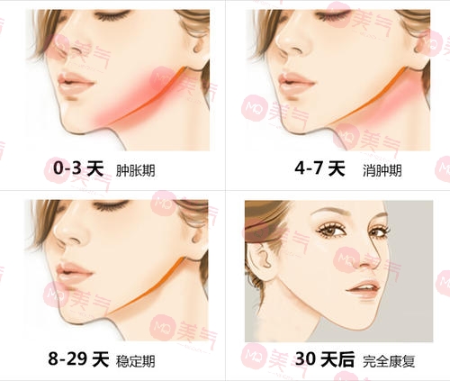 北京八大處頜面外科哪個(gè)大夫好？張智勇醫(yī)生-下頜角案例圖反饋