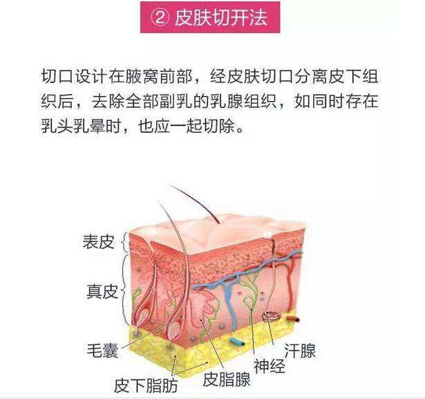 吸脂去副乳要多少錢？效果好不好？項(xiàng)目介紹和優(yōu)缺點(diǎn)盤點(diǎn)