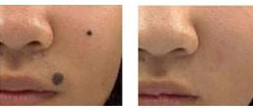 激光點痣 激光點痣