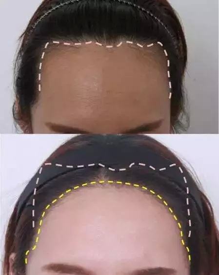 植發(fā)際線效果怎么樣？多少錢？簡介和優(yōu)缺點(diǎn)盤點(diǎn)