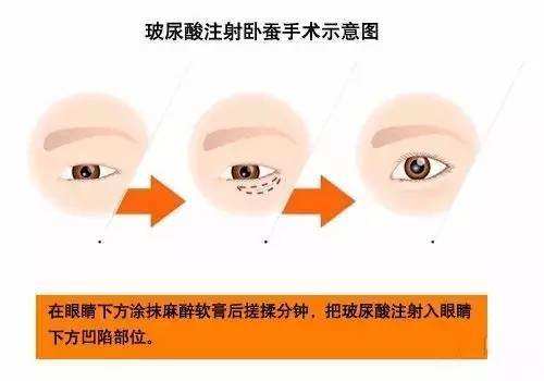 玻尿酸填臥蠶效果好不好？要多少錢？項目介紹和優(yōu)缺點盤點