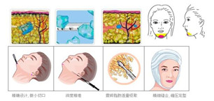 面部吸脂 面部吸脂