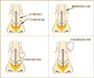 寬鼻梁矯正術(shù)真的有嗎?項(xiàng)目簡介_真實(shí)案例_優(yōu)缺點(diǎn)介紹