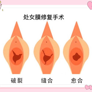 處女膜修復(fù) 處女膜修復(fù)