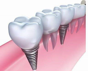 全口種植牙 全口種植牙