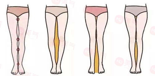 腿上抽脂究竟需要花費多少錢？