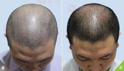 重慶毛發(fā)種植哪里有好的專業(yè)機(jī)構(gòu)嗎？