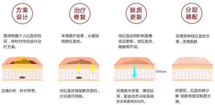 激光去紅血絲 激光去紅血絲