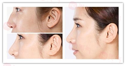 駝峰鼻治療有哪些方法？如何有效治療駝峰鼻？