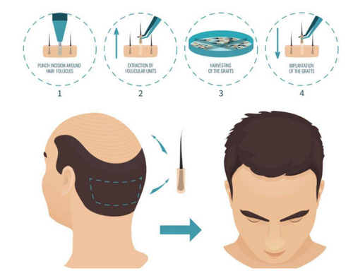 廣州倍生植發(fā)醫(yī)院技術(shù)如何？選對(duì)醫(yī)院不再為禿頭煩惱！