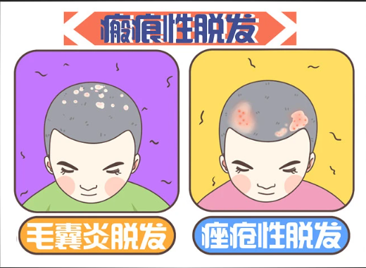 廣州倍生植發(fā)醫(yī)院技術(shù)如何？選對(duì)醫(yī)院不再為禿頭煩惱！