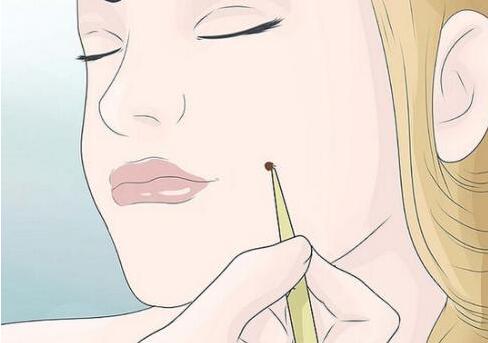 祛痣動漫01.jpg 祛痣動漫01.jpg