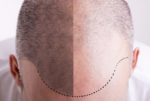 廣州首瑞植發(fā)口碑好嗎？有你青睞的發(fā)際線種植醫(yī)生嗎？