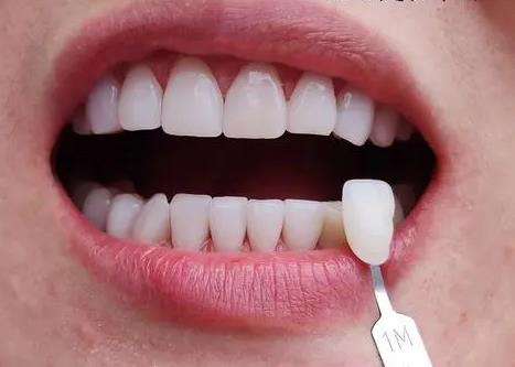 全部牙齒貼面的價(jià)格是多少？選擇材料不同相差價(jià)格較大！