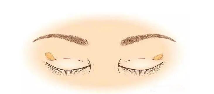 高分子壓雙眼皮3.jpg 高分子壓雙眼皮3.jpg