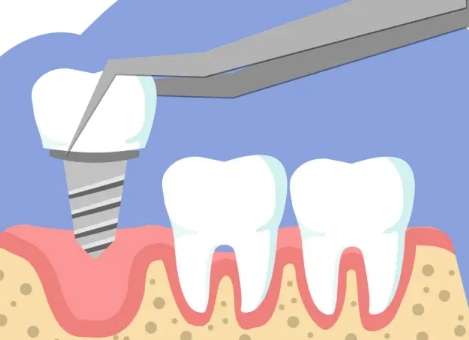 全口種牙價格是多少錢？通常情況下需要4萬元到15萬元之間