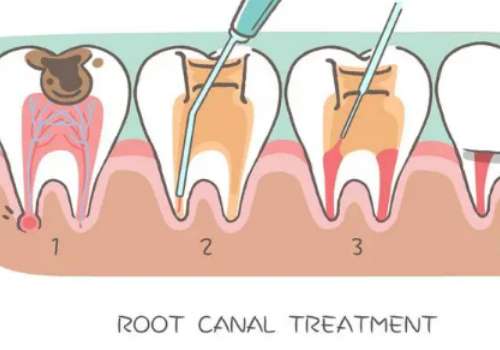 深圳牙齒矯正大概要花費多少錢？一般8000元起，具體的費用與矯正方式、醫(yī)院等級有密切的聯(lián)系