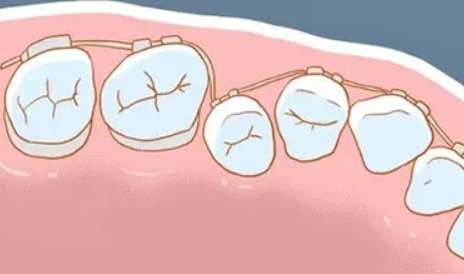 糾正牙齒需要多少錢費用？需要1萬元到5萬元之間，具體的價格要根據當地的消費水平