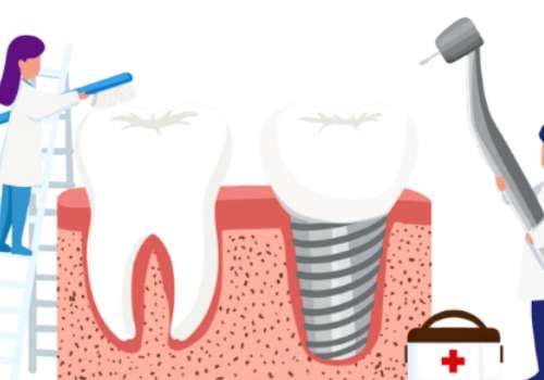 門牙種植的全部過程是什么？過程有口腔檢查、手術(shù)麻醉、種植人工牙根、等待骨結(jié)合期、牙冠修復(fù)等