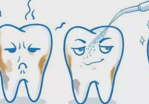 補后槽牙多少錢一顆？在200元到1000元左右，補牙的材質(zhì)不同，價格會有所差異