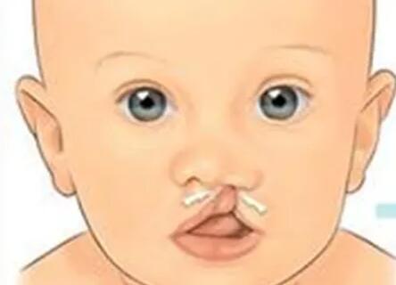 唇腭裂動(dòng)漫.jpg 唇腭裂動(dòng)漫.jpg