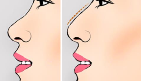 隆鼻dm3.jpg 隆鼻dm3.jpg