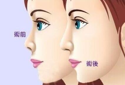 隆鼻動漫21.jpg 隆鼻動漫21.jpg