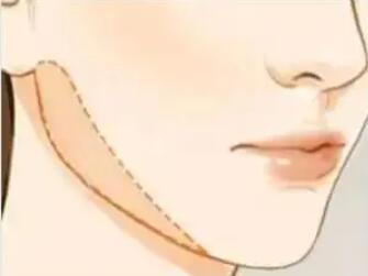 下頜角動(dòng)漫25.jpg 下頜角動(dòng)漫25.jpg