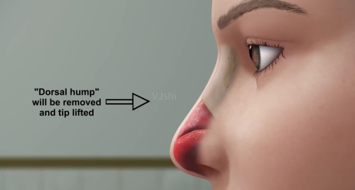 隆鼻動漫07.jpg 隆鼻動漫07.jpg