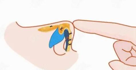 隆鼻動漫34.jpg 隆鼻動漫34.jpg