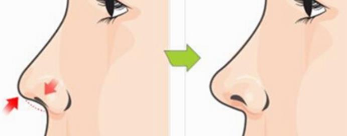 隆鼻卡通h05.jpg 隆鼻卡通h05.jpg