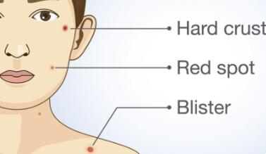 祛痣動(dòng)漫04.jpg 祛痣動(dòng)漫04.jpg