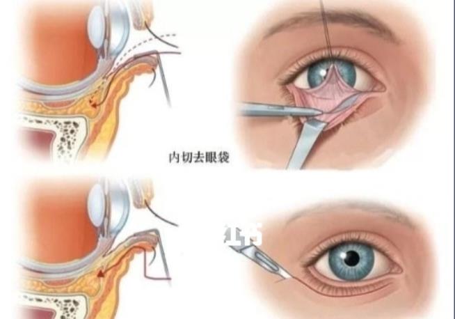 去眼袋h02.jpg 去眼袋h02.jpg