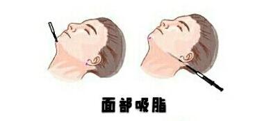 面部吸脂動漫03.jpg