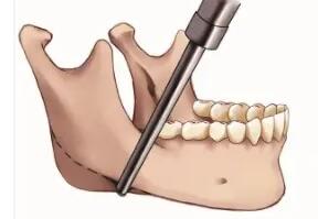 下頜角動(dòng)漫18.jpg 下頜角動(dòng)漫18.jpg
