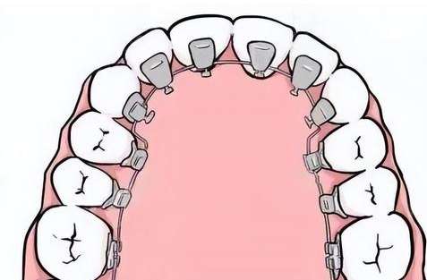 早期牙齒矯正干預(yù)多少錢？需要的費(fèi)用是5000元到15,000元之間