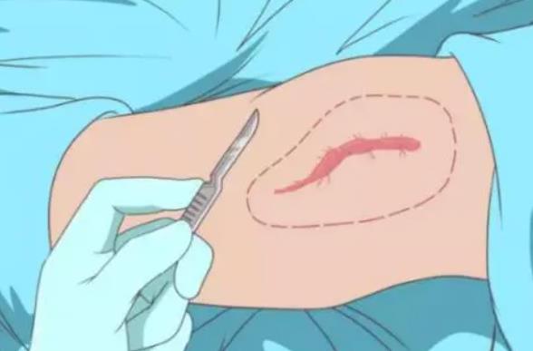 疤痕修復(fù)動漫03.jpg 疤痕修復(fù)動漫03.jpg