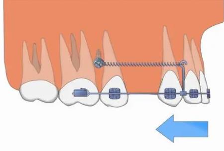 牙齒矯正hg17.jpg 牙齒矯正hg17.jpg