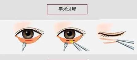 抽脂去眼袋.jpg 抽脂去眼袋.jpg