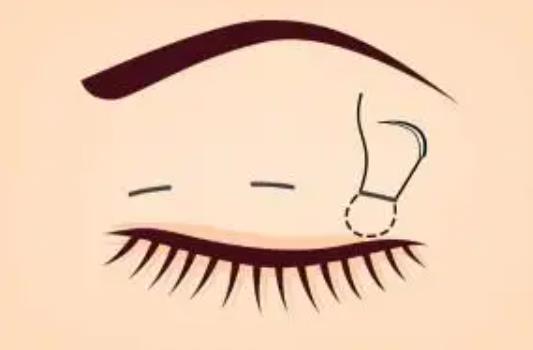 雙眼皮dm11.jpg 雙眼皮dm11.jpg