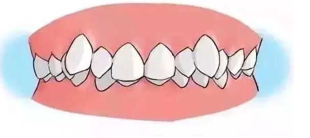 牙齒矯正動漫16.jpg 牙齒矯正動漫16.jpg