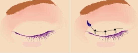 雙眼皮h15.jpg 雙眼皮h15.jpg