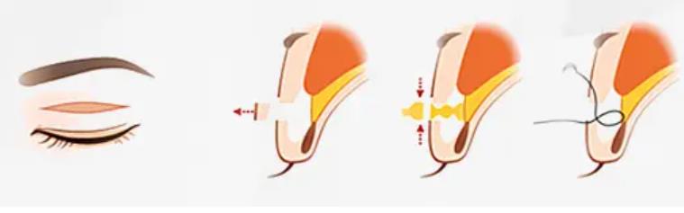 雙眼皮56.jpg 雙眼皮56.jpg