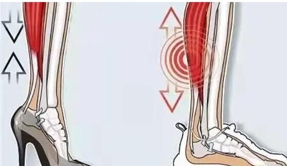 小腿神經(jīng)阻斷02.jpg 小腿神經(jīng)阻斷02.jpg