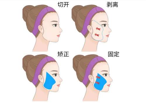 小拉皮.jpg 小拉皮.jpg