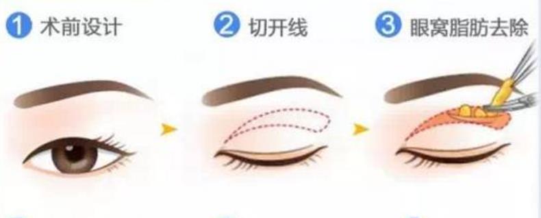 雙眼皮h12.jpg 雙眼皮h12.jpg