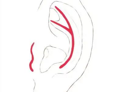 耳朵矯正動漫.jpg 耳朵矯正動漫.jpg